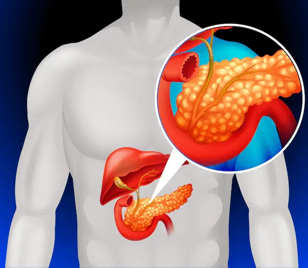 What is pancreatic cancer?